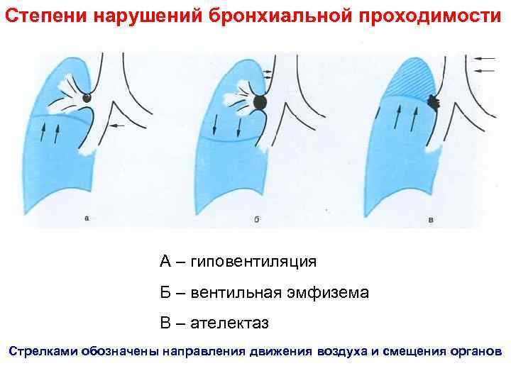 Обструктивное нарушение бронхиальной проходимости