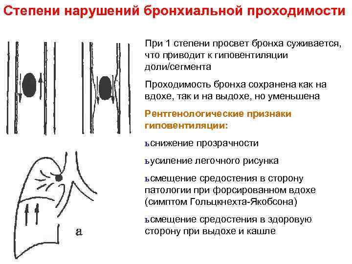 Обструктивное нарушение бронхиальной проходимости