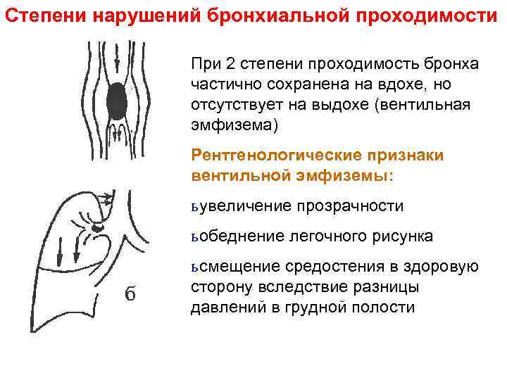 Обструктивное нарушение бронхиальной проходимости