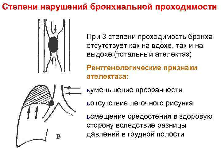 Обструктивное нарушение бронхиальной проходимости