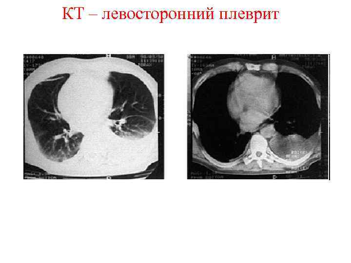 КТ – левосторонний плеврит 