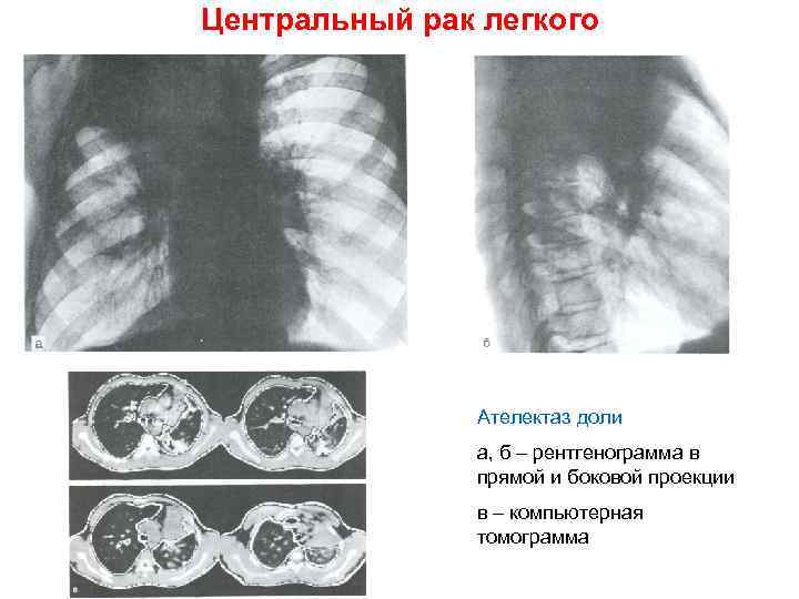 Центральный рак легкого