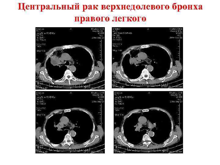 Центральный рак верхнедолевого бронха правого легкого 