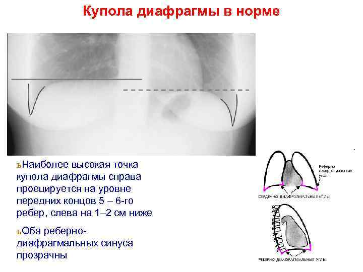 Купол диафрагмы