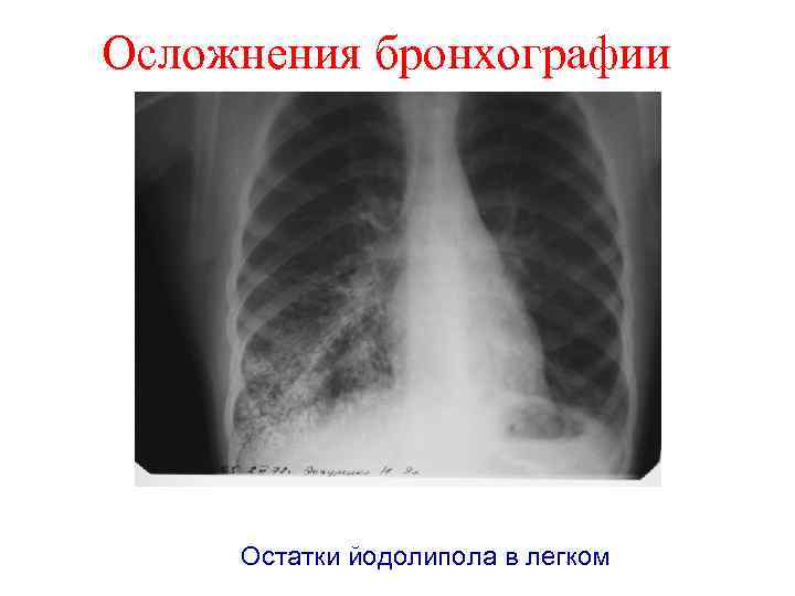 Осложнения бронхографии Остатки йодолипола в легком 
