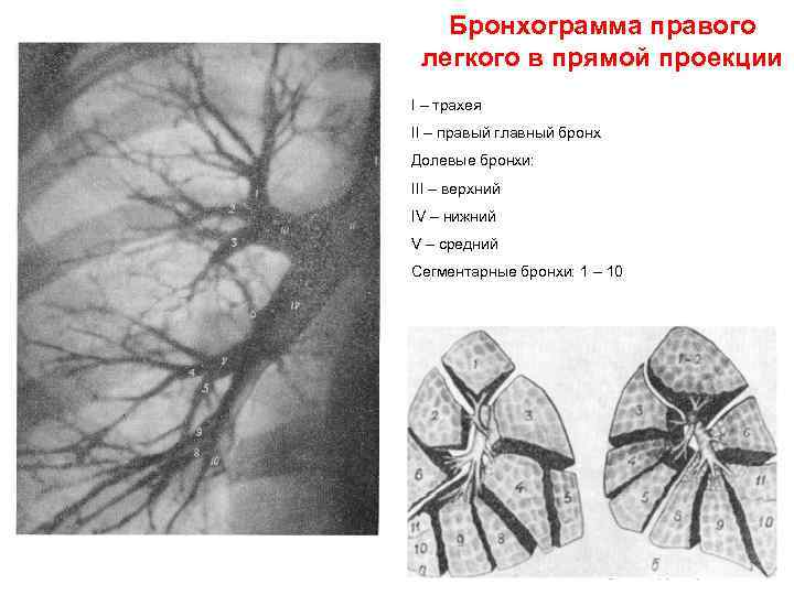Бронхограмма правого легкого в прямой проекции I – трахея II – правый главный бронх
