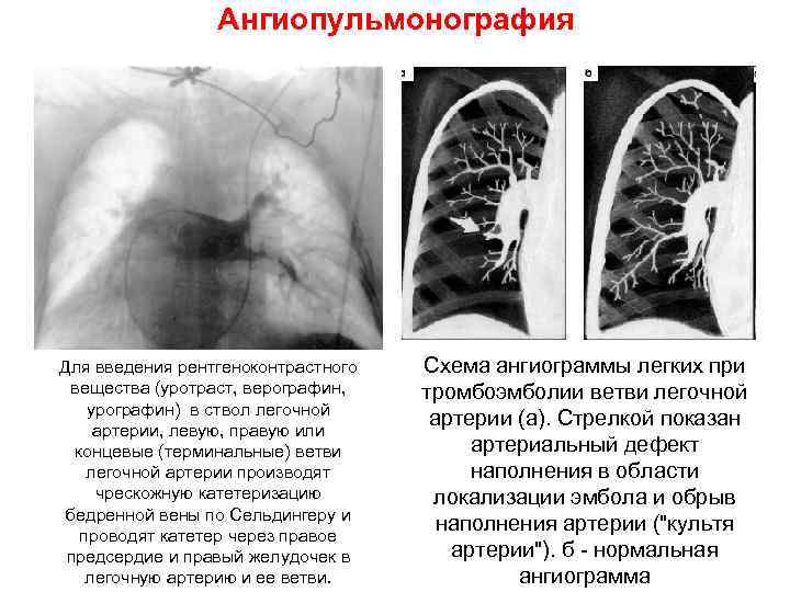 Ангиопульмонография Для введения рентгеноконтрастного вещества (уротраст, верографин, урографин) в ствол легочной артерии, левую, правую