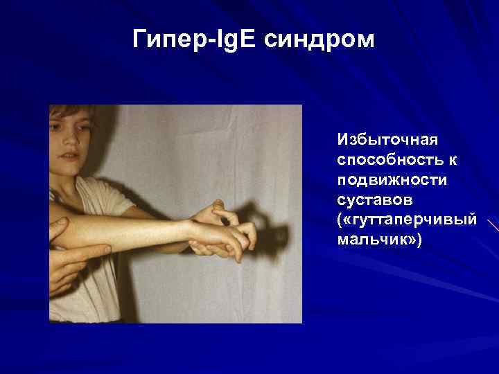 Гипер-Ig. E синдром Избыточная способность к подвижности суставов ( «гуттаперчивый мальчик» ) 