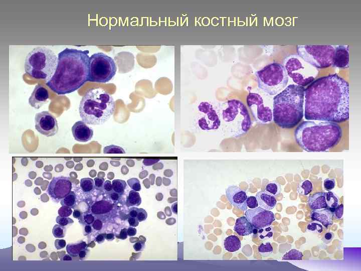 Нормальный костный мозг 
