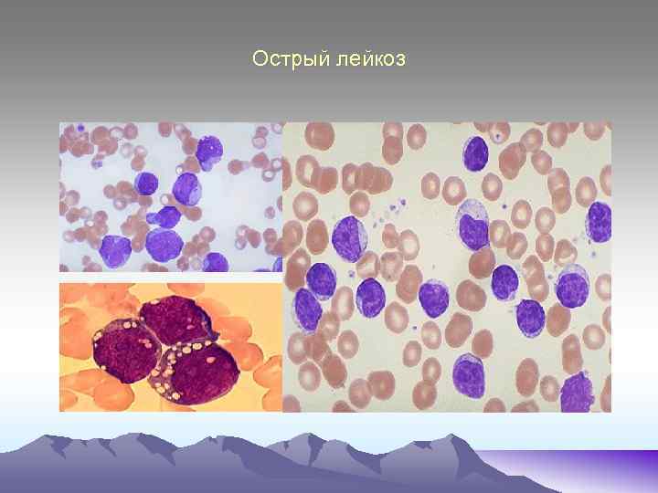 Острый лейкоз 