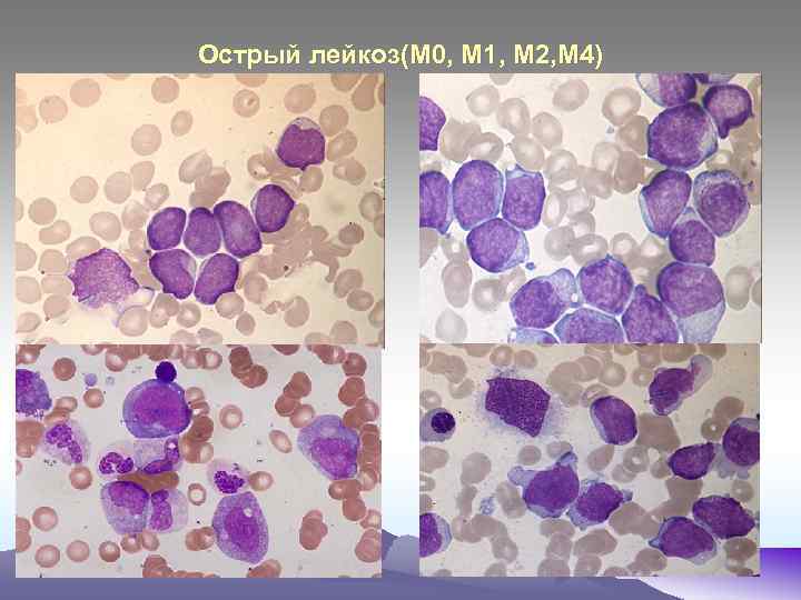Острый лейкоз(М 0, М 1, М 2, М 4) 