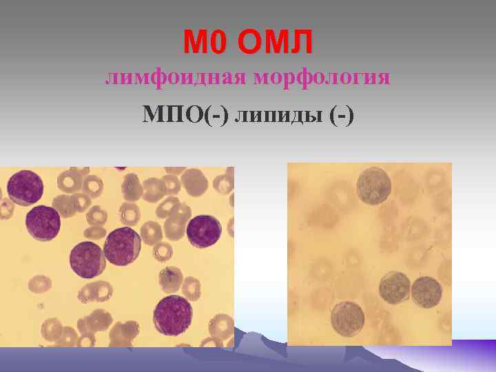 М 0 ОМЛ лимфоидная морфология МПО(-) липиды (-) 