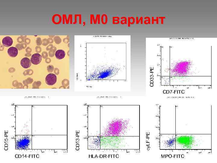 CD 33 -PE ОМЛ, М 0 вариант CD 14 -FITC cy. LF-PE CD 15