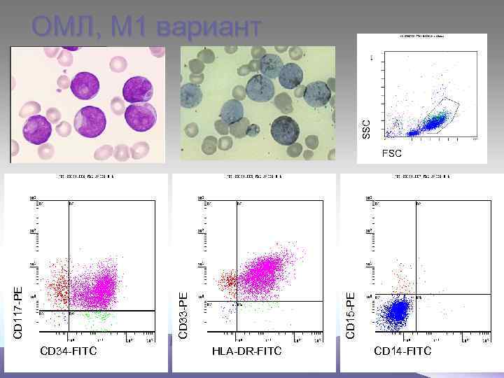 SSC ОМЛ, М 1 вариант CD 15 -PE CD 33 -PE CD 117 -PE