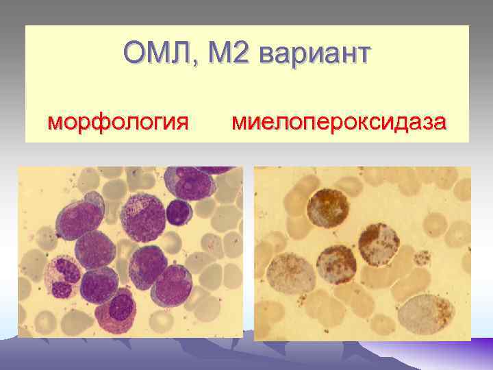 ОМЛ, М 2 вариант морфология миелопероксидаза 
