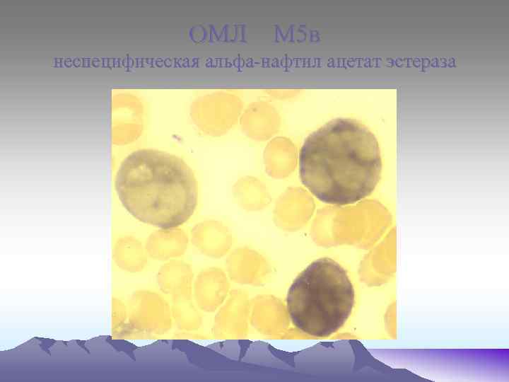 ОМЛ М 5 в неспецифическая альфа-нафтил ацетат эстераза 