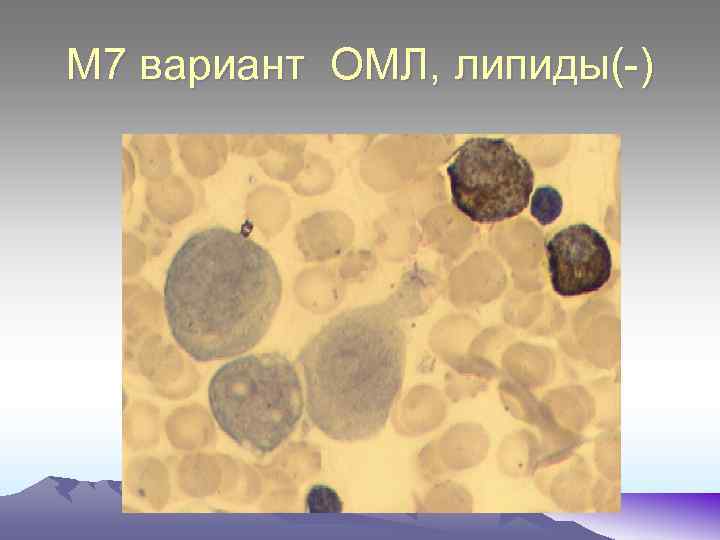 М 7 вариант ОМЛ, липиды(-) 