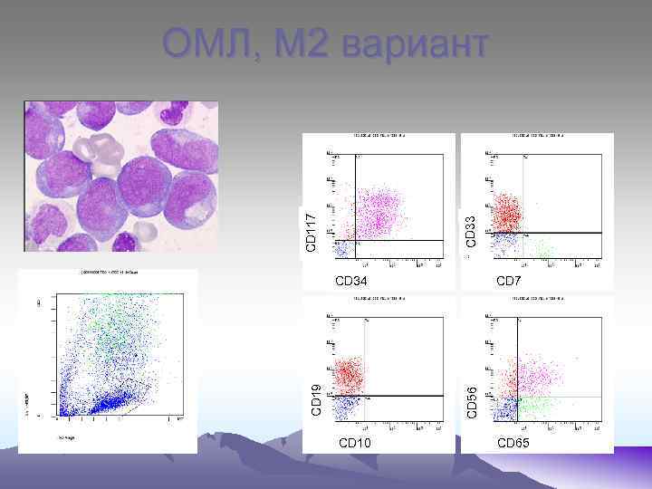CD 33 CD 117 ОМЛ, М 2 вариант CD 7 CD 56 CD 19