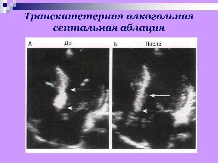 Транскатетерная алкогольная септальная аблация 