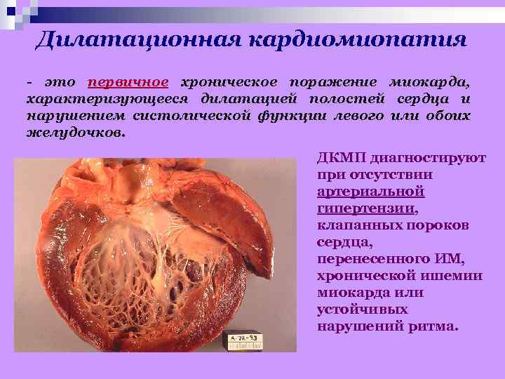 Дилатационная кардиомиопатия - это первичное хроническое поражение миокарда, характеризующееся дилатацией полостей сердца и нарушением