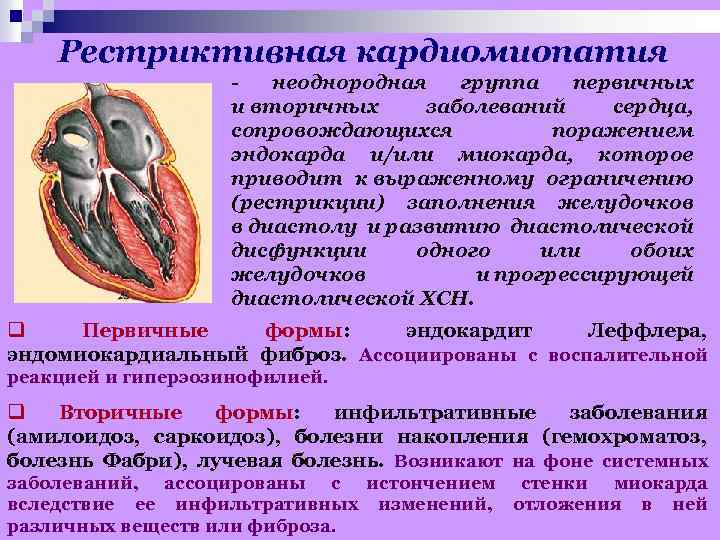 Рестриктивная кардиомиопатия - неоднородная группа первичных и вторичных заболеваний сердца, сопровождающихся поражением эндокарда и/или