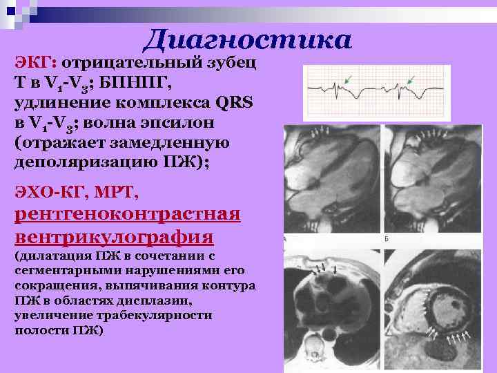 Диагностика ЭКГ: отрицательный зубец Т в V 1 -V 3; БПНПГ, удлинение комплекса QRS
