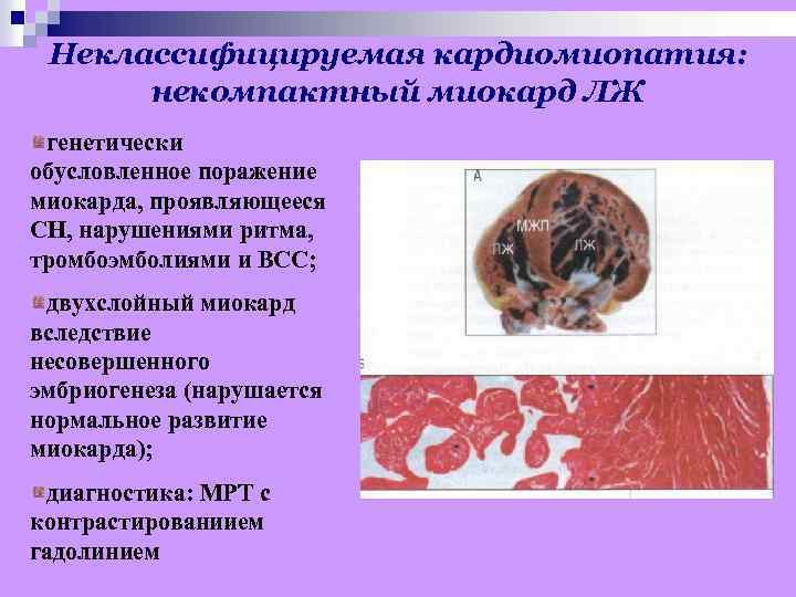 Неклассифицируемая кардиомиопатия: некомпактный миокард ЛЖ генетически обусловленное поражение миокарда, проявляющееся СН, нарушениями ритма, тромбоэмболиями