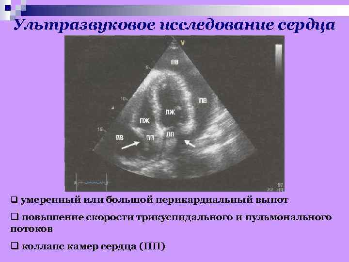 Ультразвуковое исследование сердца q умеренный или большой перикардиальный выпот q повышение скорости трикуспидального и