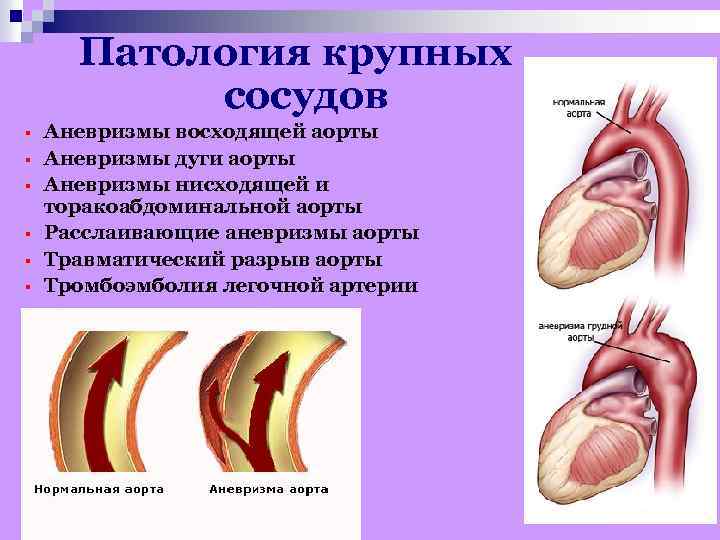 Патология крупных сосудов § § § Аневризмы восходящей аорты Аневризмы дуги аорты Аневризмы нисходящей
