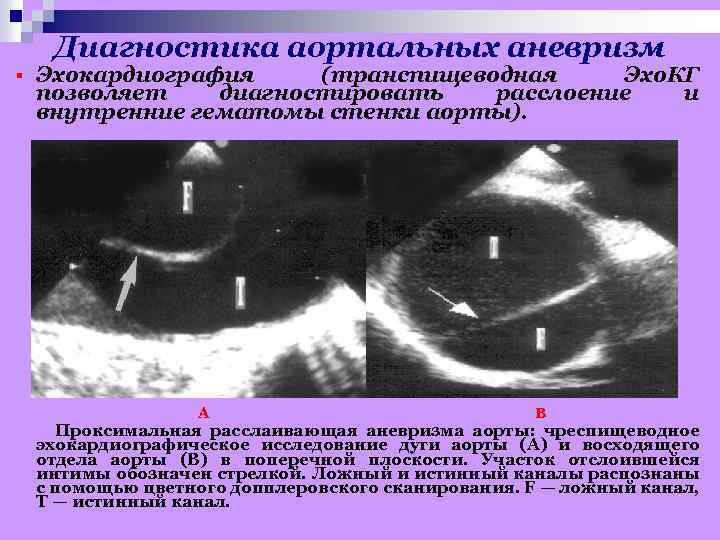 Диагностика аортальных аневризм § Эхокардиография (транспищеводная Эхо. КГ позволяет диагностировать расслоение и внутренние гематомы