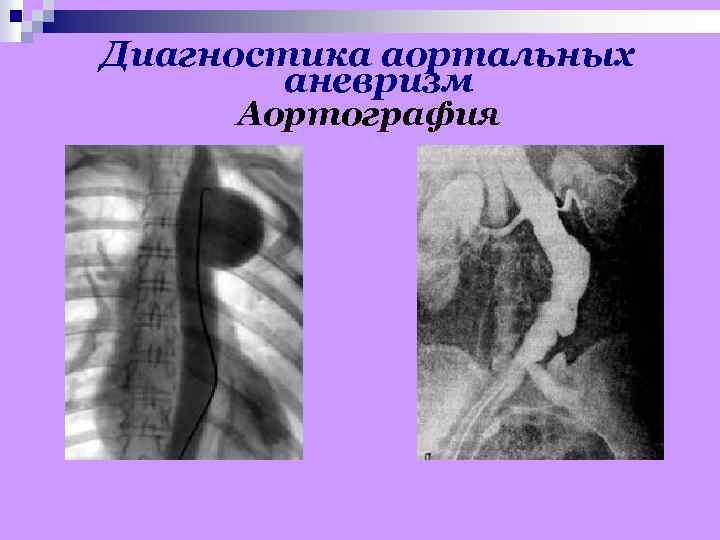 Диагностика аортальных аневризм Аортография 