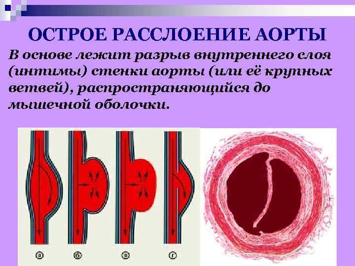 Стенки аорты. Острое расслоение аорты. Расслоение стенки аорты. Отслоение стенки аорты. Диссекция стенки аорты.