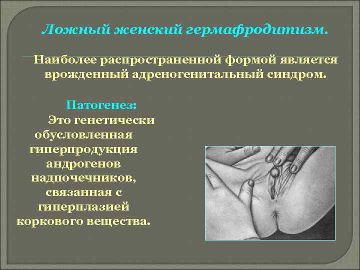 Ложный женский гермафродитизм. Наиболее распространенной формой является врожденный адреногенитальный синдром. Патогенез: Это генетически обусловленная