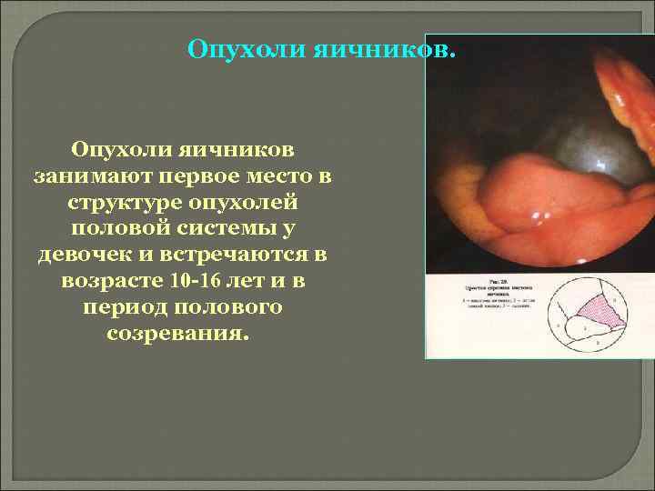Опухоли яичников. Опухоли яичников занимают первое место в структуре опухолей половой системы у девочек