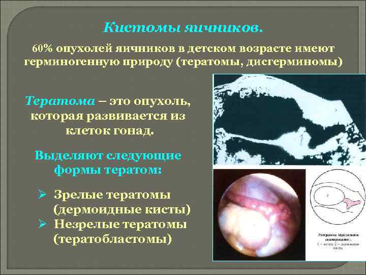 Кистомы яичников. 60% опухолей яичников в детском возрасте имеют герминогенную природу (тератомы, дисгерминомы) Тератома