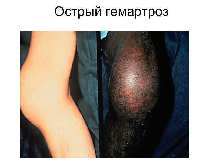 Острый гемартроз 