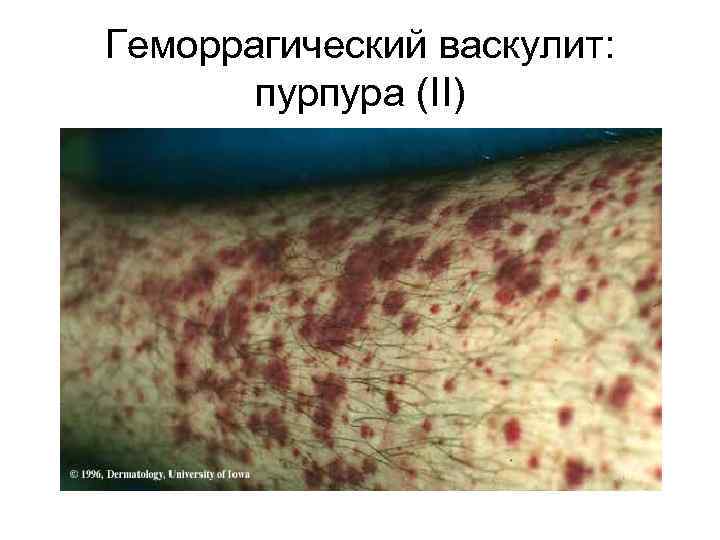 Геморрагический васкулит: пурпура (II) 