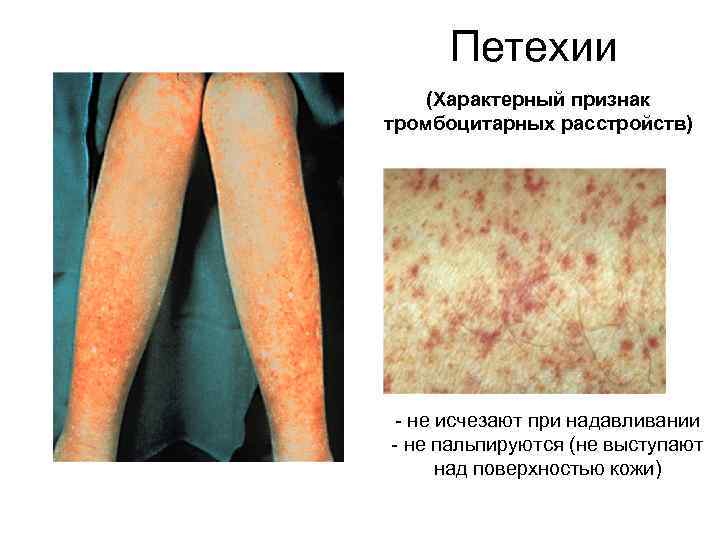 Петехии (Характерный признак тромбоцитарных расстройств) - не исчезают при надавливании - не пальпируются (не