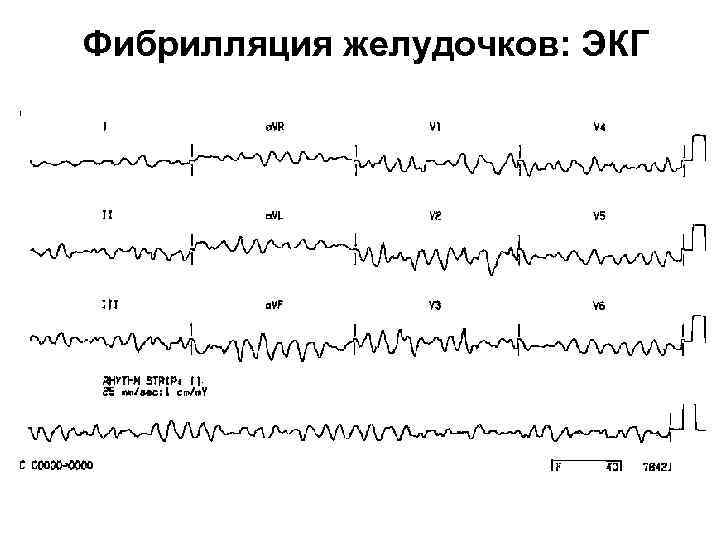 Фибрилляция желудочков: ЭКГ 