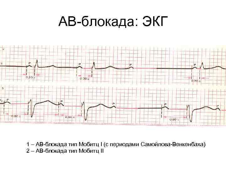 АВ-блокада: ЭКГ 1 – АВ-блокада тип Мобитц I (с периодами Самойлова-Венкенбаха) 2 – АВ-блокада