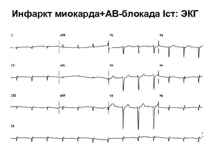 Инфаркт миокарда+АВ-блокада Iст: ЭКГ 