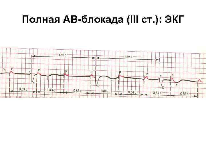Полная АВ-блокада (III ст. ): ЭКГ 