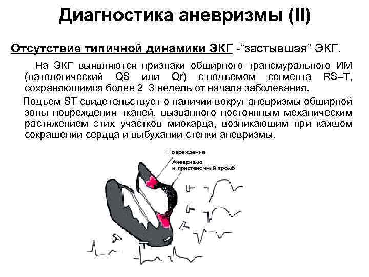 Диагностика аневризмы (II) Отсутствие типичной динамики ЭКГ -“застывшая” ЭКГ. На ЭКГ выявляются признаки обширного