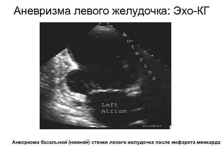Аневризма левого желудочка: Эхо-КГ Аневризма базальной (нижней) стенки левого желудочка после инфаркта миокарда 