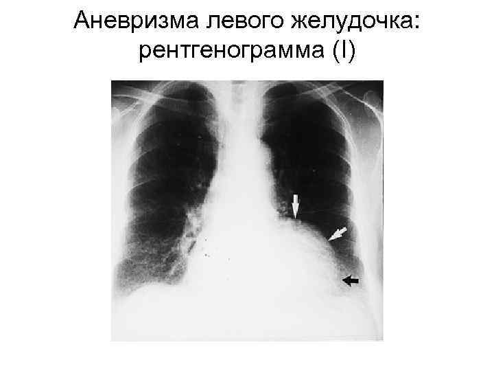 Аневризма левого желудочка: рентгенограмма (I) 