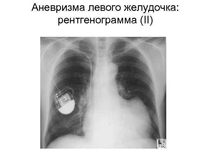 Аневризма левого желудочка: рентгенограмма (II) 