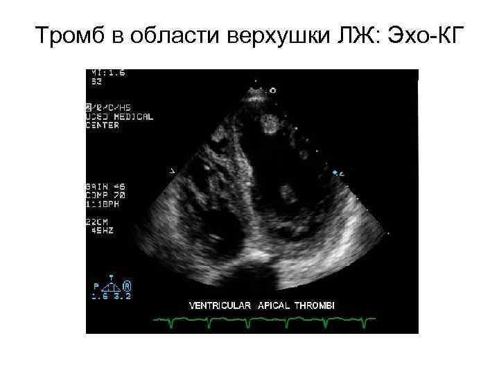 Тромб в области верхушки ЛЖ: Эхо-КГ 