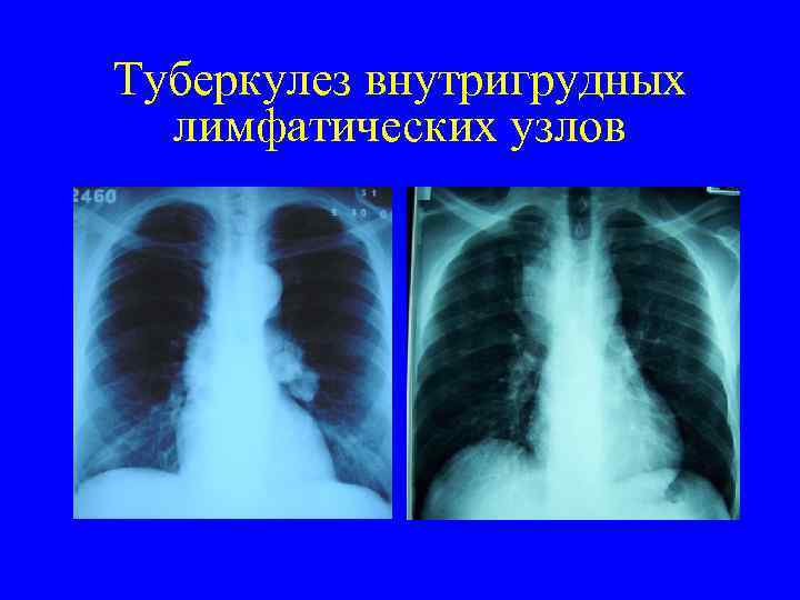 Туберкулез внутригрудных лимфатических узлов 