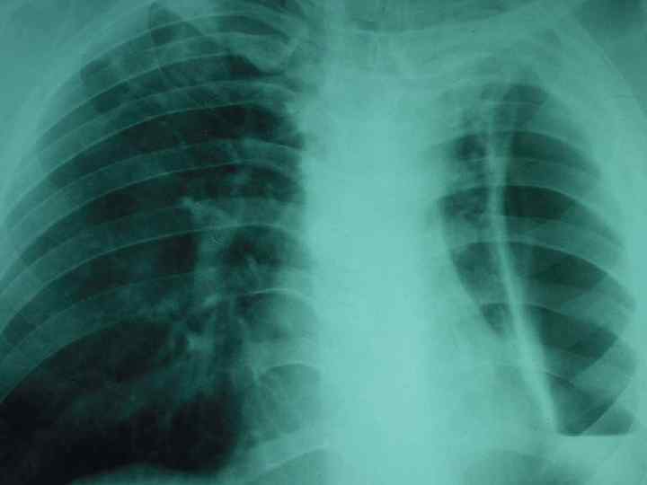Туберкулёзный плеврит Туберкулёзный плеврит (Туб. П) (внелёгочный