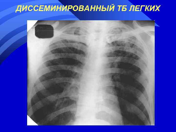 ДИССЕМИНИРОВАННЫЙ ТБ ЛЕГКИХ 